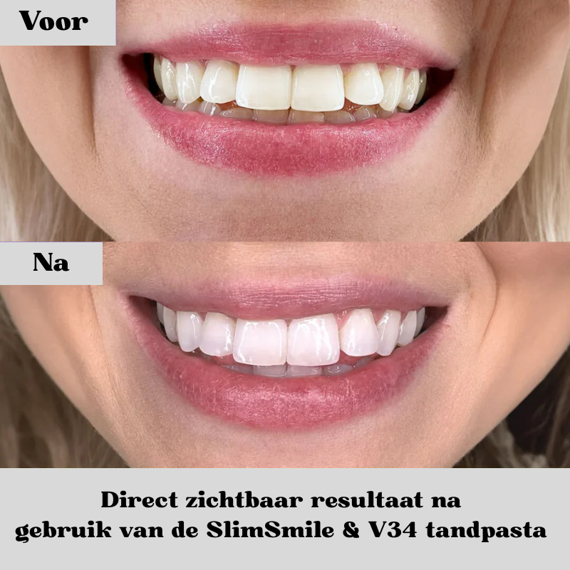 SmileLux™ – Luxury Home Whitening – Free Delivery Today
