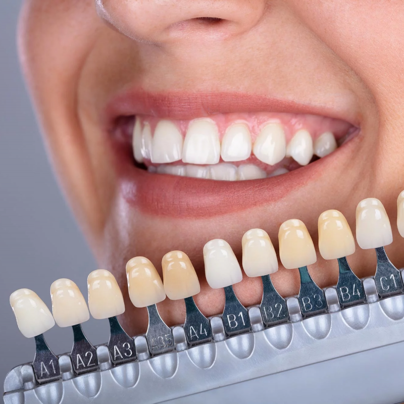 SmileLux™ – Luxury Home Whitening – Free Delivery Today